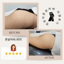 경기튼살커버 채우림튼살커버문신 리얼후기와 전후사진