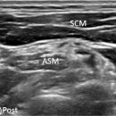 3. LEVEL III: MIDDLE JUGULAR NODES 이미지