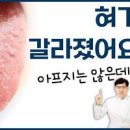 혓바닥 갈라짐 혀 가운데 갈라짐 원인 및 치료방법 이미지