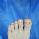 오스본병원 | 의왕 군포 내성 발톱무좀 치료 병원 비수술 케어 후기