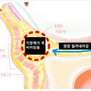 50대 눈밑지방재배치 수술후 전후사진 보여드립니다.