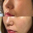 부산서면피부과 볼뉴머300샷+슈링크300샷 볼링크후기