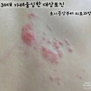 한아름요양병원 | 대상포진 증상 및 후기(30대 오른쪽 등부터 가슴까지 통증 없이 가려움 심함)
