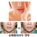 V라인S라인 이미지