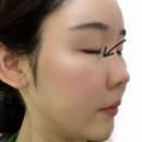 블루미의원 | * 자연스럽게 볼륨 채우고 싶어서 울트라콜 받았어요 (눈밑꺼짐 개선 후기) 블루미의원