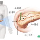 가장 무서운 암인 췌장암 증상 이미지