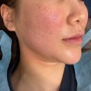 휴한의원 | 부산 서면 한의원에서 튠페이스 이중턱 리프팅 내돈내산 솔직후기