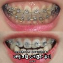 [서울 노원] 성인 오픈바이트 개방교합 6개월 중간점검 치아 교정 치료 내돈내산 솔직 찐후기
