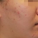 튼튼나무의원 | 봄철 알레르기 증상 총정리_눈물, 콧물, 피부는 왜 뒤집어 질까?