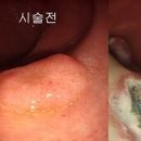 대장암 초기 증상 1기 2기 3기 4기 말기 증상 차이와 치료 이미지