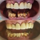 신안기공사 | 앞니 브릿지, 90세 환자분 당일로 편하게 브릿지 완성