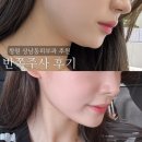 진주사 | 상남동피부과 바노바기창원 반쪽주사 이중턱 전후비교 후기