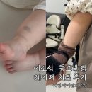 몽고반점 | 이소성몽고반점 치료후기 / 대전 아이엠피부과 / 보험청구방법(현대해상)