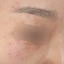 화정 메이퓨어 편평 사마귀 제거 시술 받은 솔직 후기(시술 전 후 사진 있음)