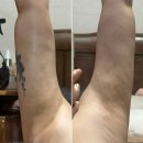 방이정형외과의원 | W.예신 팔뚝 지방흡입 수술후기 과정 및 바본관리 휴고성형외과의원 (3)