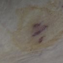 동백요양병원 | 퇴원하고 한방병원으로 전원하여 요양