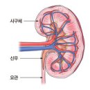 만성 신부전 ( CRF - Chronic renal failure) 이미지