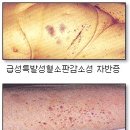 자반증(자반병), 면역 혈소판감소증 이미지