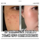 청주 에스테틱 네일바이미뷰티 멜라리티 기미제거 후기