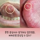 용성메디칼 | 류마내과에서 베체트병 진단 받을 때 주의할 점 [산청군, 남해군, 사천시]