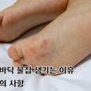 발바닥 물집 새끼 발가락 발에 물집 생겼을때 터뜨리기 : 원인 연고 대법 이미지