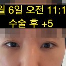 여우조명 | 눈밑지 눈밑지방재배치 부작용 눈매변화, 눈 작아짐, 여우눈 일주일 후기