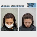 영헤어라인 이미지