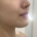 연희동자치회관 | 연희동 피부관리 &lt;뮤즈뷰티&gt; 무통리프팅 효과 전후비교