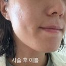 강남 논현 피부과 버츄RF 고주파니들 레이저 솔직 후기, 모공이랑 탄력 고민 해결법