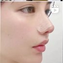 무보형물 기증늑 내돈내산 코성형 코수술 후기 / 당일 멍 붓기 통증 준비물