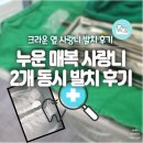 사랑니 발치 후기 | 누운 매복 사랑니 2개 동시 발치 + 크라운 어금니 옆