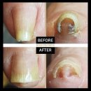 홀드핀칭 이미지