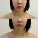 5336 | 평택 윤곽관리 잘하는 곳 “뜰에스테틱 고덕점” 작은 얼굴 + 얼굴 비대칭 관리 후기