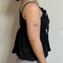 멍이랑 | 구로 팔 뒷볼록 지방추출주사 2주차, 멍이 확 빠진 직장인 리얼후기