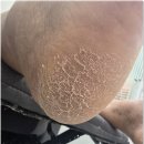리오풋케어 | 청계천발각질 전문샵 방문 후기 리오풋케어 내성발톱 무좀발톱 발각질 네일 문제성발