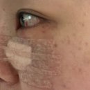 삼일약국 | 스마일 라식 후 눈밑지방재배치 수술 후기..2주차!!