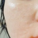 2022_2_강남역-1 | [내돈내산 후기] 강남역피부과 리쥬란힐러 2cc 시술 1~7일차 후기 ㄹㅇ 있음 (엠보 빵빵)