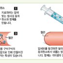 비호지킨 림프종 치료 이미지