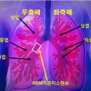 이식 3개월째 기관지가 좁아져서 스텐트 시술 했습니다 이미지