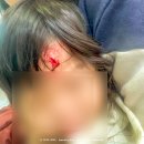 건국대학교충주병원 | 16개월 아기 이마 찢어짐 사고 응급처치 후기｜충주 건대병원 응급실