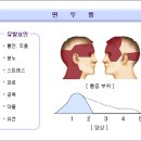 편두통의 원인과 치료 이미지