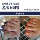 발톱무좀 문제성 손발 전문샵에서 개선이 가능하다고? #닥터네일 #페디크루 #청주 이미지