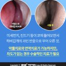 비중격 만곡증 , 코휘어짐 코막힘 비염 이미지