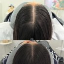 솔 에스엠피(SMP) | 서울 두피케어 닷츠에서 여자 정수리 가르마 탈모 고민 해결 완료!