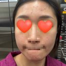 고양이세수 | 고양이 털알러지로 염증성 여드름 두달간 고생한 리얼후기(*혐짤주의)