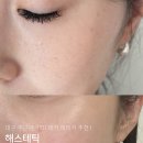 대구 주근깨 제거 레이저 후기 / 해스테틱 추천
