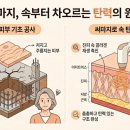이든피부과의원 | 써마지300 vs 600샷, 병원에서 절대 안 알려주는 진짜 차이