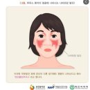 중증루푸스신염의 정의 및 진단확정[전신성홍반성루푸스라는 자가면역성 장애에 의한 신장질병의 한 형태] 이미지