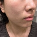 콜라스터포텐자 : 을지로입구역피부과 겨울 예민한 피부 관리 추천