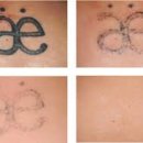 신레이저 이미지